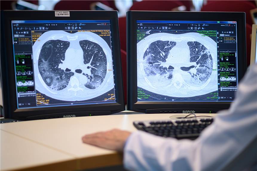 US-Studie: Long-Covid-Symptome treten auch nach leichten Krankheitsverläufen auf 73.000 Probanden, die einst mit Corona infiziert waren, nahmen an einer Studie teil. Das Ergebnis zeigt, dass Langzeitfolgen von Covid-19 unterschiedliche Organe betreffen können - und vor allem Männer betroffen sind.
