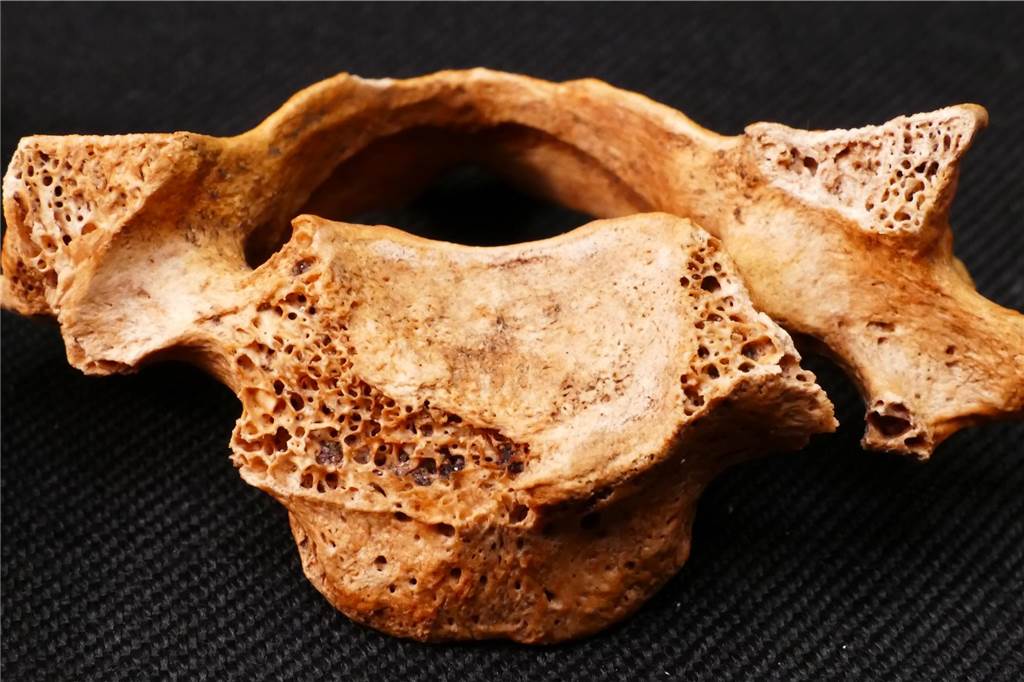Neue Ergebnisse zum geköpften Sekelett an der Nienborger Burg Halswirbel des geköpften Skeletts in der Nieborger Burg