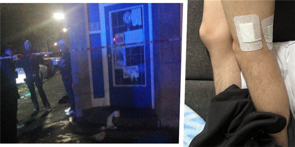28-Jähriger wurde in der Nordstadt angeschossen: „Ich hätte tot sein können“ An der Ecke Zimmerstraße/Priorstraße in der Nordstadt wurde am Montag (10.10) auf eine Gruppe geschossen. Dabei wurde ein 28-Jähriger zweimal am Bein getroffen. Die Folgen sind auf dem rechten Bild zu sehen.