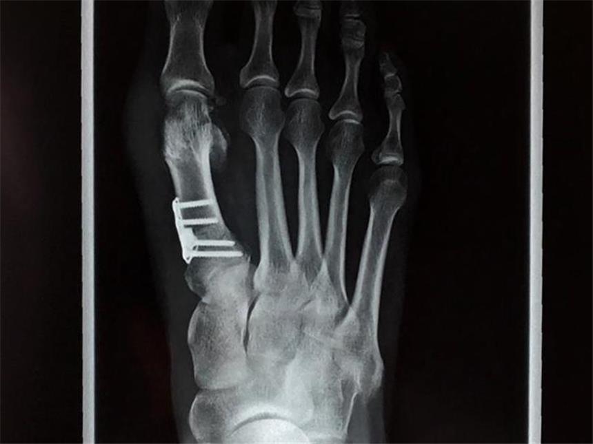 Fußgymnastik, Schienen oder OP? Was beim Hallux valgus hilft Bei diesem Fuß wurde die schiefstehende Großzehe mittels einer sogenannten "Open Wedge Osteotomie" korrigiert. Foto: dpa-tmn