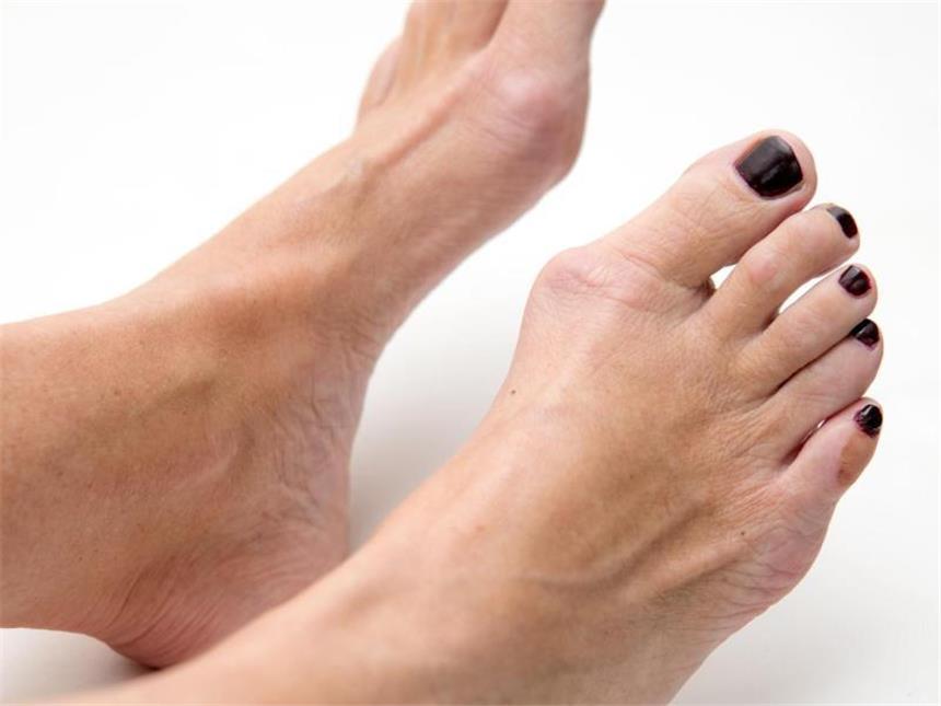 Fußgymnastik, Schienen oder OP? Was beim Hallux valgus hilft Beim Ballenzeh, dem sogenannten Hallux valgus, hat sich das Großzehengrundgelenk verschoben. Dadurch steht die große Zehe schief. Foto: Andrea Warnecke/dpa-tmn