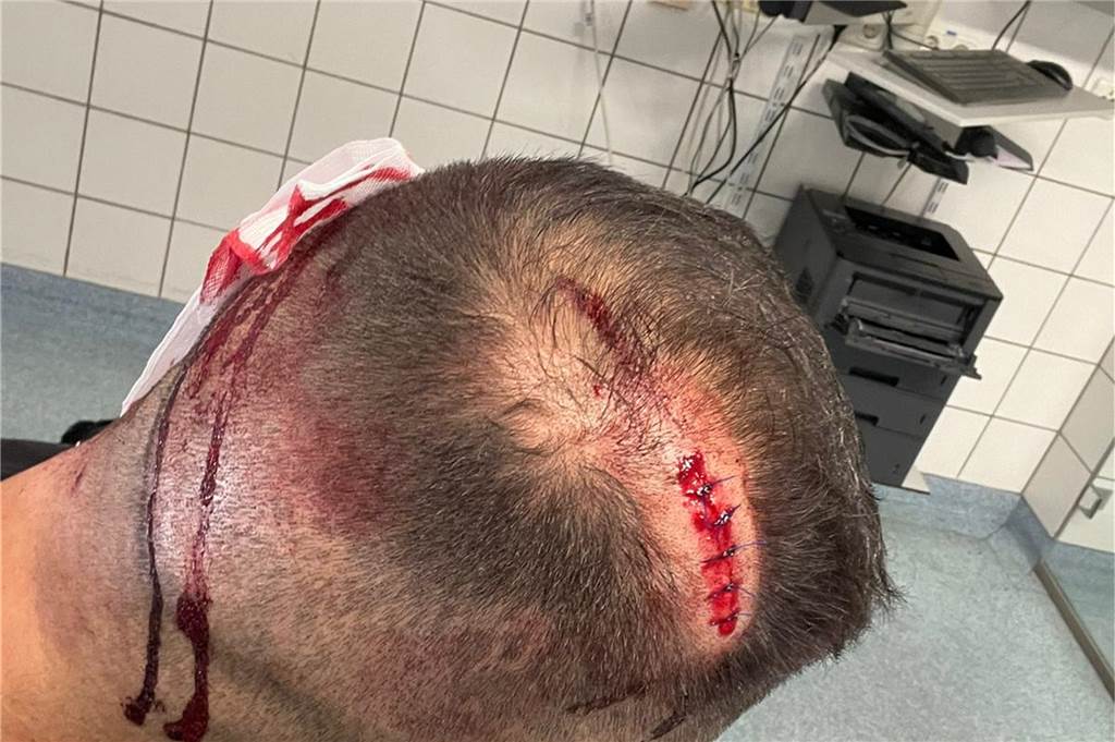 asdfasdf: asdfasdfasdf Bekir Günaydins Bruder musste an mehreren Stellen am Kopf genäht werden.