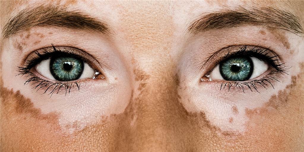 Sabrina Husmanns seltene Hauterkrankung: „Die Flecken gehören zu mir!“ Sabrina Husmann aus Haltern leidet an Vitiligo. Man sagt dazu auch Weißfleckenkrankheit.