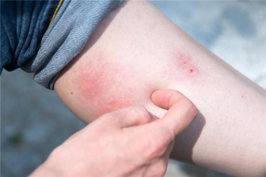 Was bei juckenden Mückenstichen zu tun ist Bitte nicht kratzen! Mückenstiche werden besser gekühlt oder mit einem Präparat aus der Apotheke behandelt. Foto: Andrea Warnecke