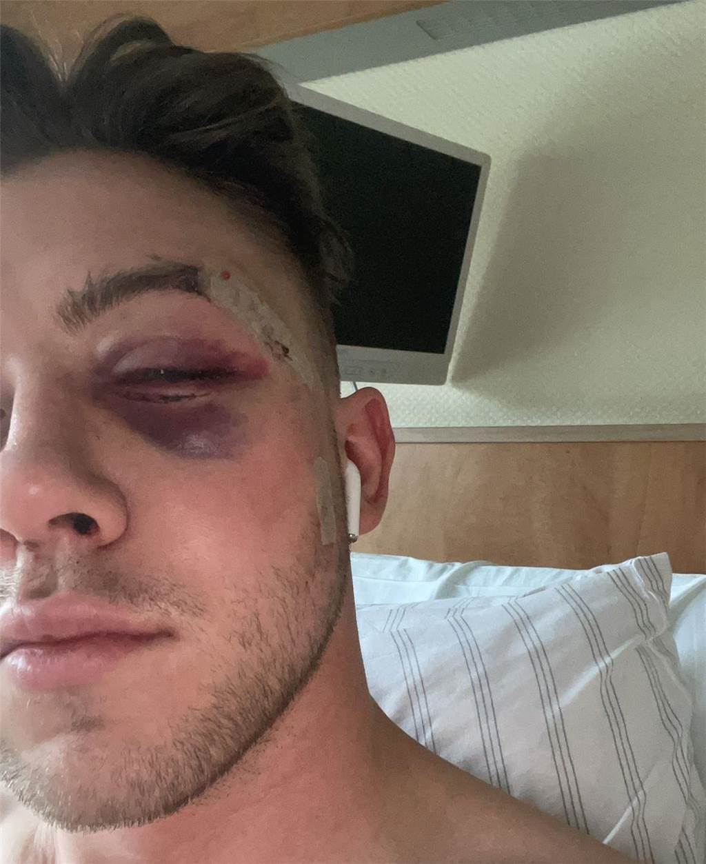 Wickede-Torwart nach Spiel operiert: Überraschende Aussagen trotz etlicher Knochenbrüche Das Auge von Julian Heitmann ist nach dem Zusammenstoß zugeschwollen.