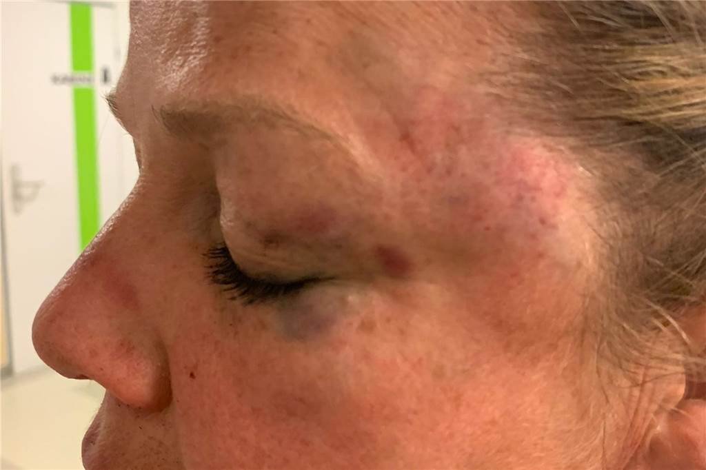 Dagmar S. mit blauem Auge.
