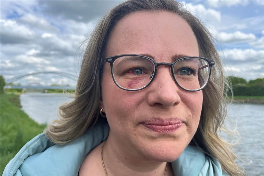 Bergkamenerin will ihren Hund retten: „Ich dachte, der bringt mich um“ Nahaufnahme von dem Gesicht einer Frau, mit blauem Fleck unterm und Einblutung im Auge.