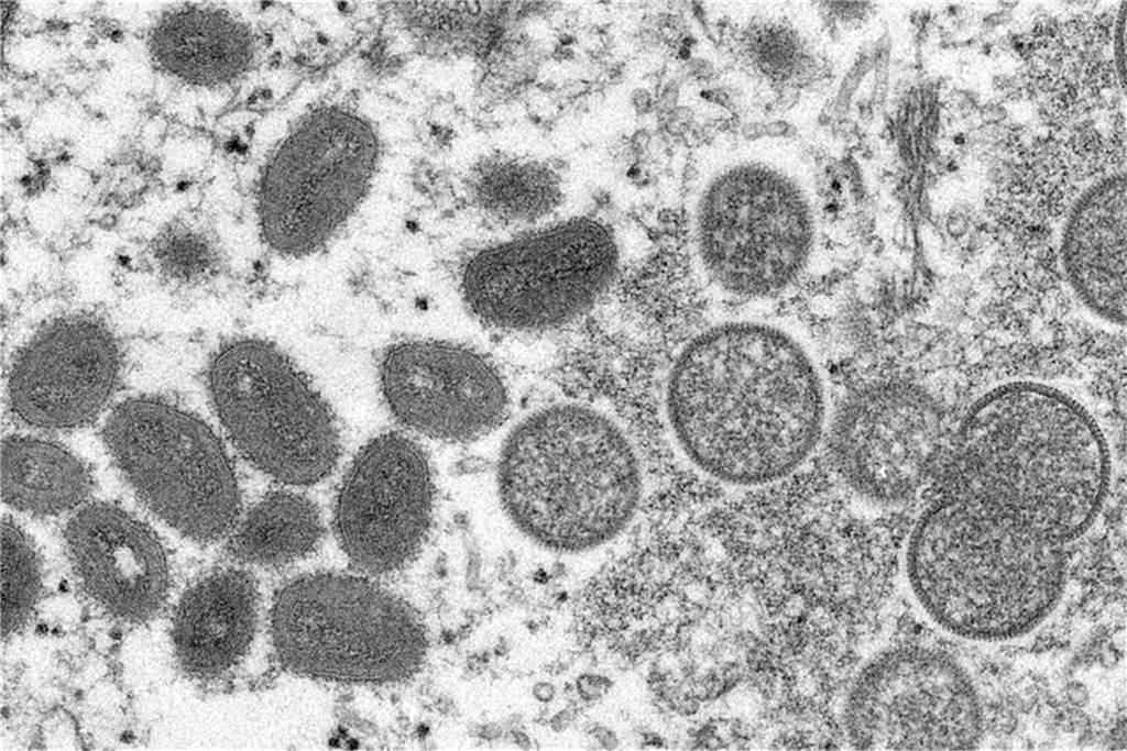 Affenpocken in Deutschland: Ist das Virus gefährlich? Alles, was Sie wissen müssen Diese elektronenmikroskopische Aufnahme zeigt reife, ovale Affenpockenviren (l) und kugelförmige unreife Virionen (r), die aus einer menschlichen Hautprobe stammt.