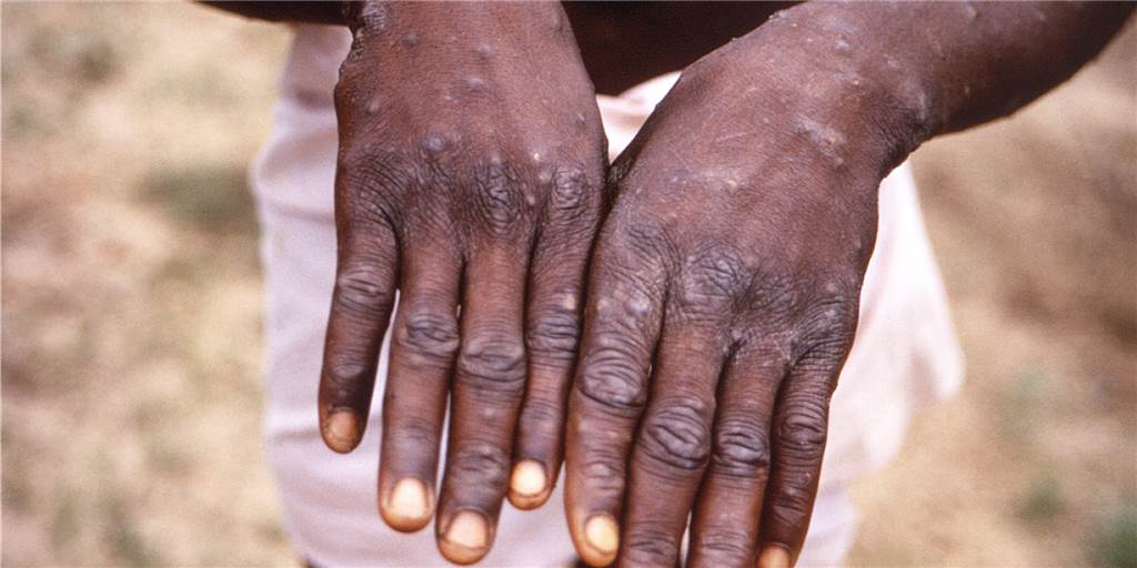 Affenpocken-Ausbruch: Warum Stigmatisierung ein Problem für alle ist Dieses Bild aus dem Jahr 1997 zeigt die Rückenflächen der Hände eines Affenpocken-Patienten.