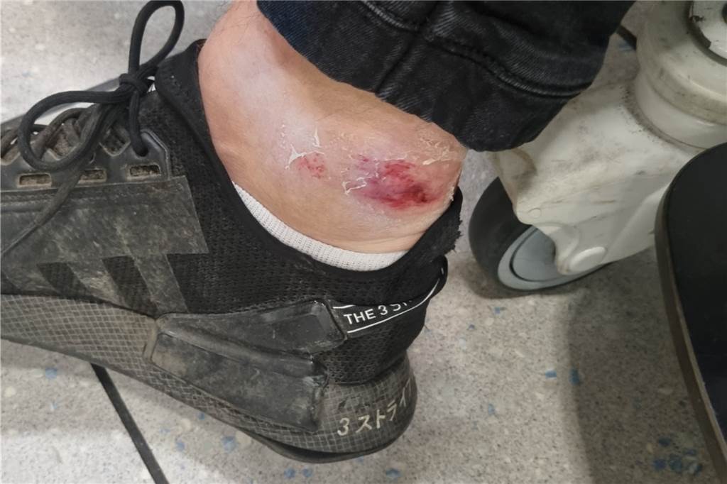 Krankenhaus statt Karussell: Maximilian (24) wurde auf Osterkirmes verletzt Ein blutiger Knöchel in einem schwarzen Turnschuh.
