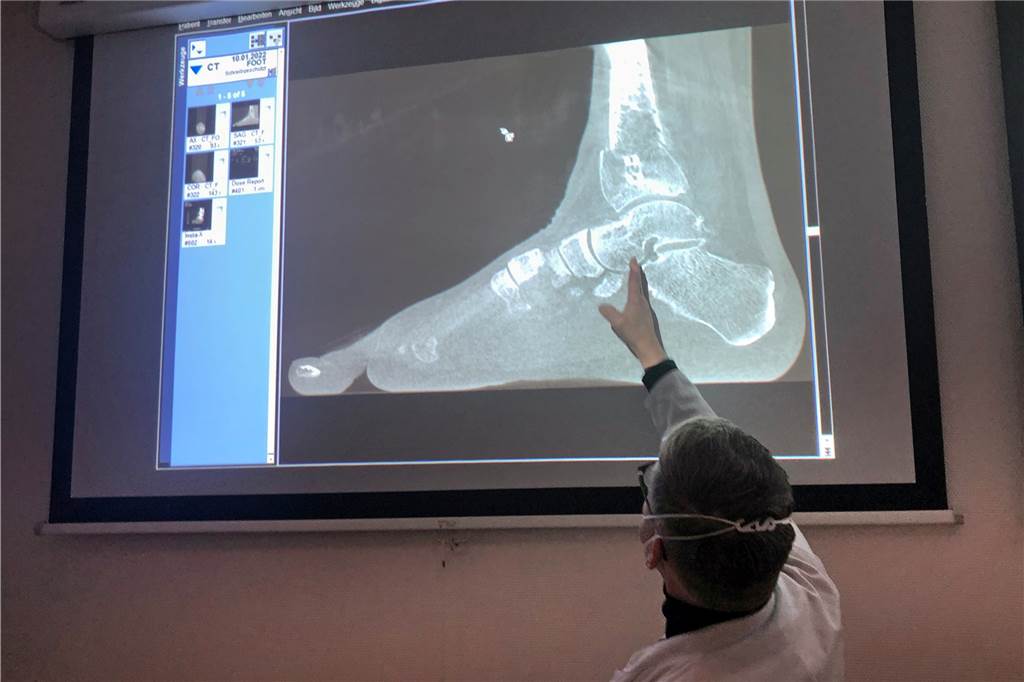 Fuß- und Handchirurgie am Rochus: 3D-Tomograph bedeutet Quantensprung Dr. Uwe Klapper kann auf den Aufnahmen jede Schraube bis Gewinde hinein erkennen und so auch den Sitz prüfen. Das ist zum Beispiel bei Nach-Operationen wichtig.