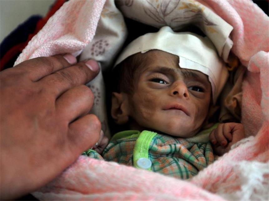 20 Millionen Menschen droht in Afrika der Hungertod Ein Arzt untersucht ein drei Monate altes stark unterernährtes Kind im Ernährungszentrum in Sanaa (Jemen). Foto: Yahya Arhab/Archiv