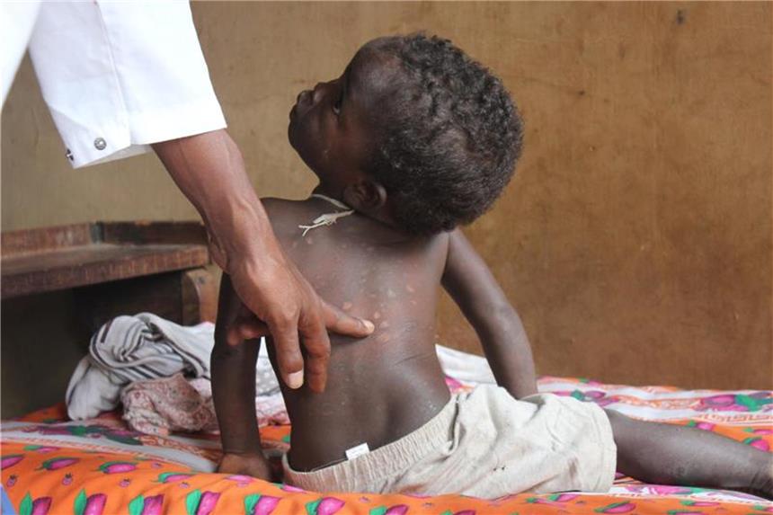 Stigma und Krankheit erfassen Zehntausende Lepra-Infizierte Ein zweijähriges Kind wird in Marana auf Madagaskar auf eine mögliche Lepra-Erkrankung untersucht. Foto: Laetitia Bezain