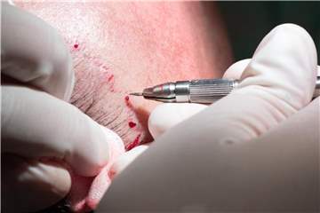 Hier sollen bald neue Haare wachsen: Ein Chirurg setzt die Empfaengerkanaele fuer die anstehende Haartransplantation an der Stirn eines Patienten. Foto: Andrea Warnecke