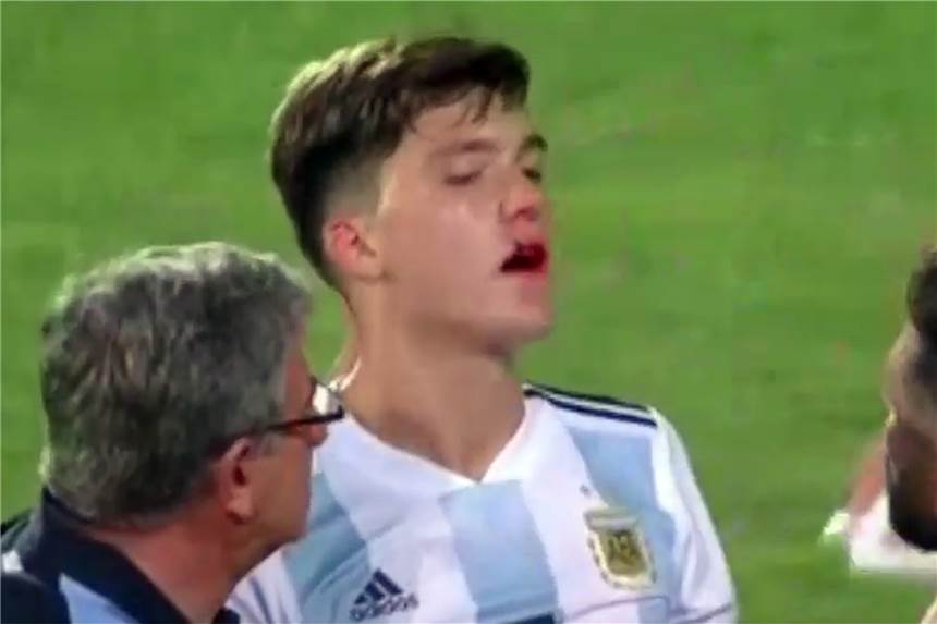 U20-Meisterschaft für BVB-Neuzugang Leonardo Balerdi vorzeitig beendet Im Spiel gegen Uruguay zog sich Balerdi eine Verletzung in der Mundhöhle zu.