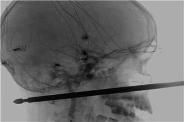 In einer sehr riskanten Operation entfernten Ärzte in der Klinik der University of Kansas den Metallspieß. Foto: Medical News Network