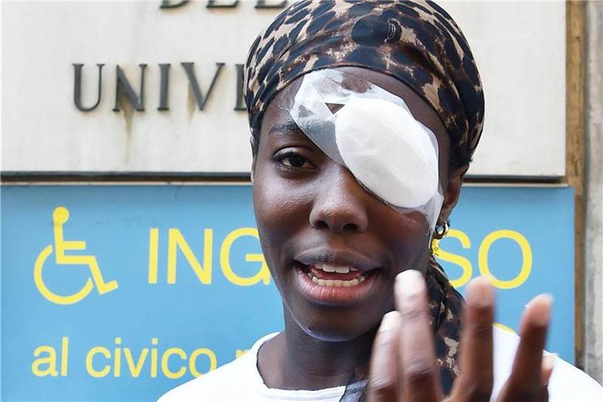 Leichtathletin Daisy Osakue zeigt die Folgen der Eierwurf-Attacke. Foto: Alessandro Di Marco/ANSA/AP
