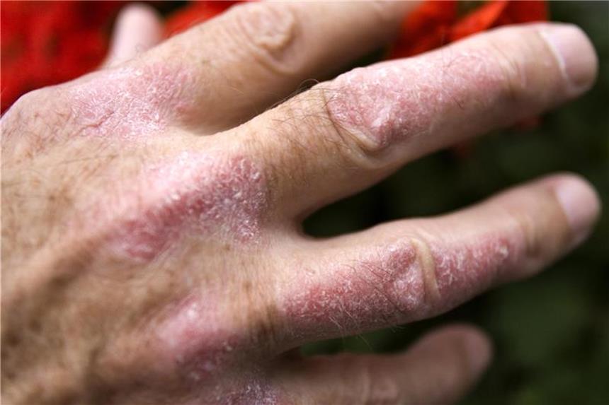 Schuppenflechte kann auch das Sexualleben beeinträchtigen Menschen mit Schuppenflechte an den Händen können Berührungen oft nur schlecht vertragen. Foto: Arno Burgi
