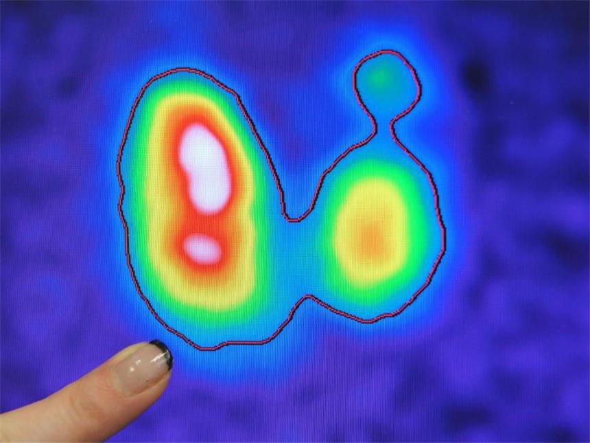 Viele Überdiagnosen bei Schilddrüsenkrebs Mit einer speziellen Kamera erstellt: Die Schilddrüse eines erkrankten Patienten wird auf einem Monitor dargestellt. Foto: Jan-Peter Kasper/Archiv