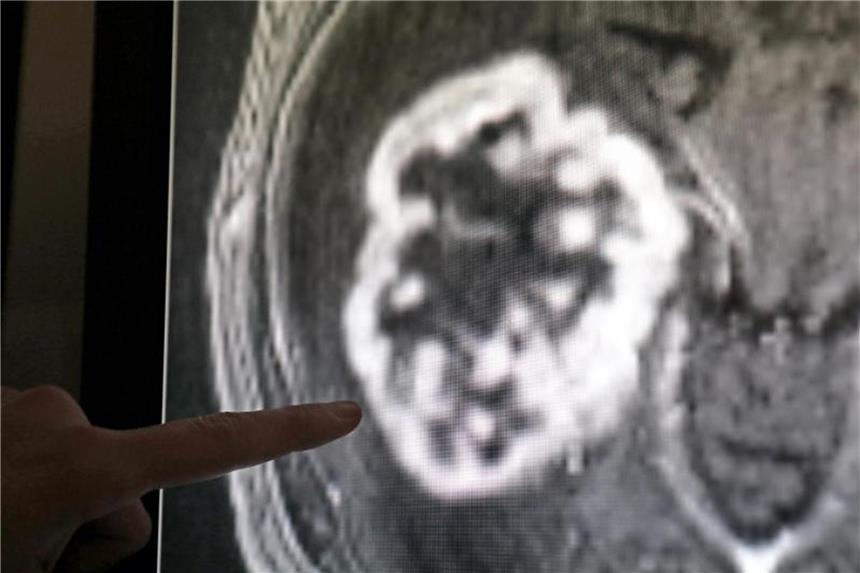 Risiko für Krebspatienten durch Kliniken mit wenig Erfahrung Mit Hilfe der Magnetresonanztomographie kann ein Tumor festgestellt werden. Foto: Bernd Wüstneck/dpa