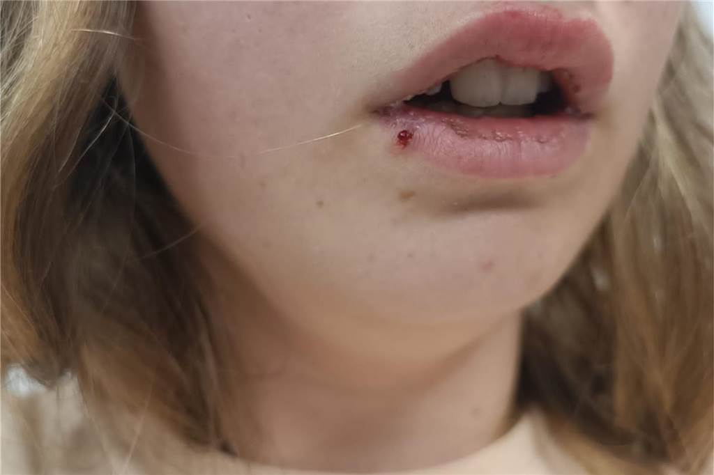 15-Jährige von Gleichaltrigen schwer verletzt: „Oft träume ich davon“ Nur eines von mehreren Fotos der verletzten Janine. Nicht alle sind aber für die Öffentlichkeit bestimmt.