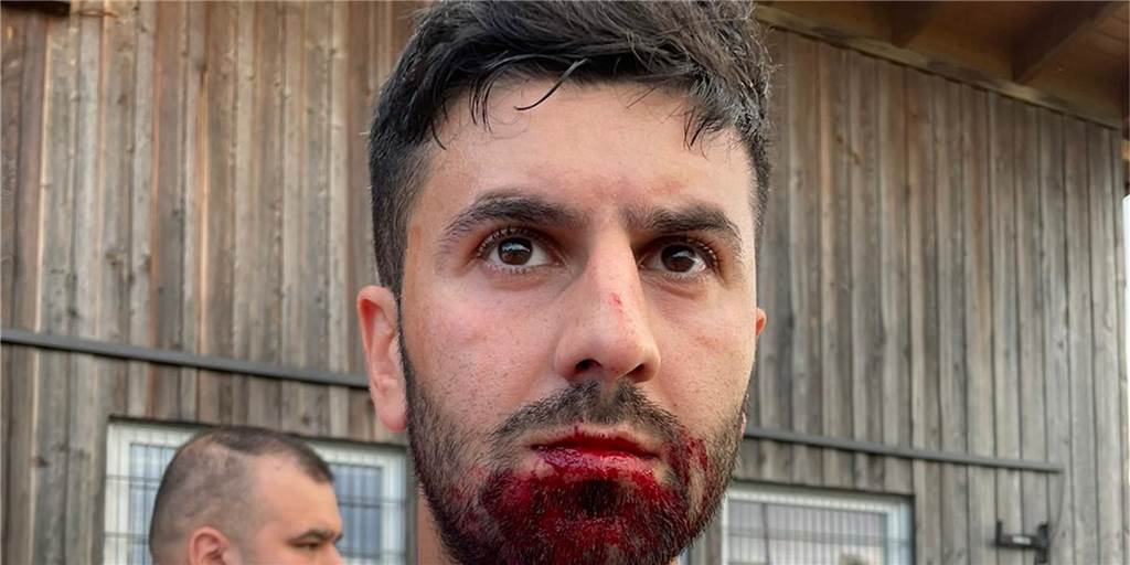 Nach Faustschlag und Spielabbruch auf Schwerin: „Meine Hände waren blutüberströmt“ Serkan Aydin, Spieler vom TuS Hattingen, zeigt seine Verletzung aus der Partie gegen die Spvg Schwerin.