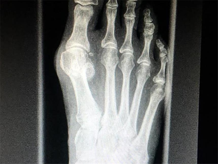 Fußgymnastik, Schienen oder OP? Was beim Hallux valgus hilft So sieht ein Hallux valgus auf einer Röntgenaufnahme aus. Foto: dpa-tmn