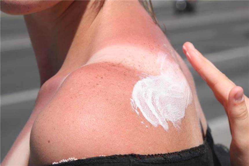 Krebsraten steigen ungebremst Sonnencreme beugt Hautkrebs vor. „Ein Irrglaube“, warnt der Tübinger Hautkrebsexperte Garbe. Die Haut könne durch Sonnenschutzmittel nicht komplett vor Hautkrebs geschützt werden. Foto: Stephanie Pilick