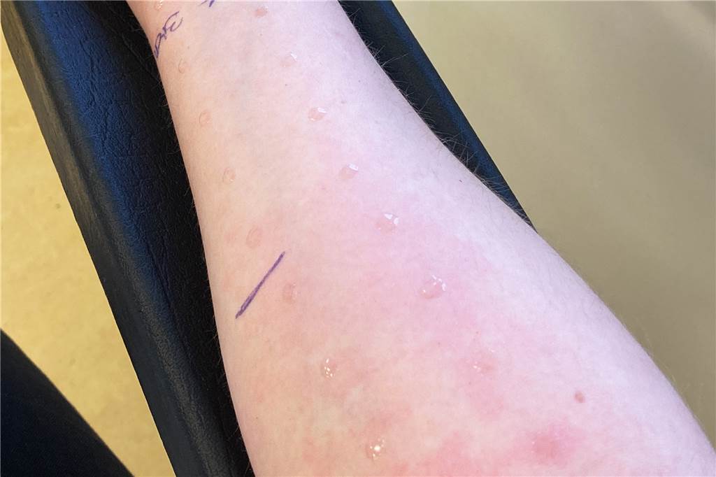 Pollen im Anflug: So können Allergiker ihren Heuschnupfen abmildern Vor einer Hyposensibilisierung wird bei einem sogenannten Pricktest ermittelt, wie die Haut auf bestimmte Allergene reagiert.