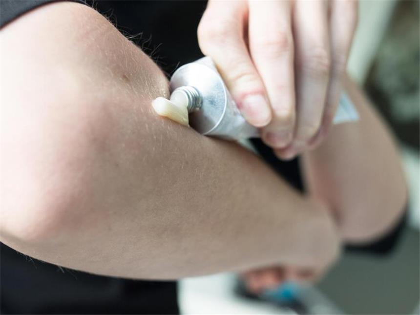 Cortison - Segen und Fluch eines hochwirksamen Medikaments Wer eine Zeit lang eine cortisonhaltige Salbe verwenden muss, braucht sich keine Sorgen zu machen. Die Nebenwirkungen sind gering, außerdem wirken die Präparate häufig schnell und können zügig wieder abgesetzt werden. Foto: Franziska Gabbert/dpa-tmn