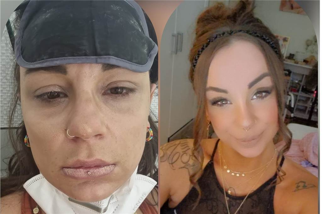 Mit einem Zeckenbiss begann der Albtraum: „Ich darf nicht aufgeben“ Zwei Selfies zeigen Marie-Christin Jeske aus Dortmund-Wellinghofen vor und nach ihrer Erkrankung. Sie leidet an ME/CFS.